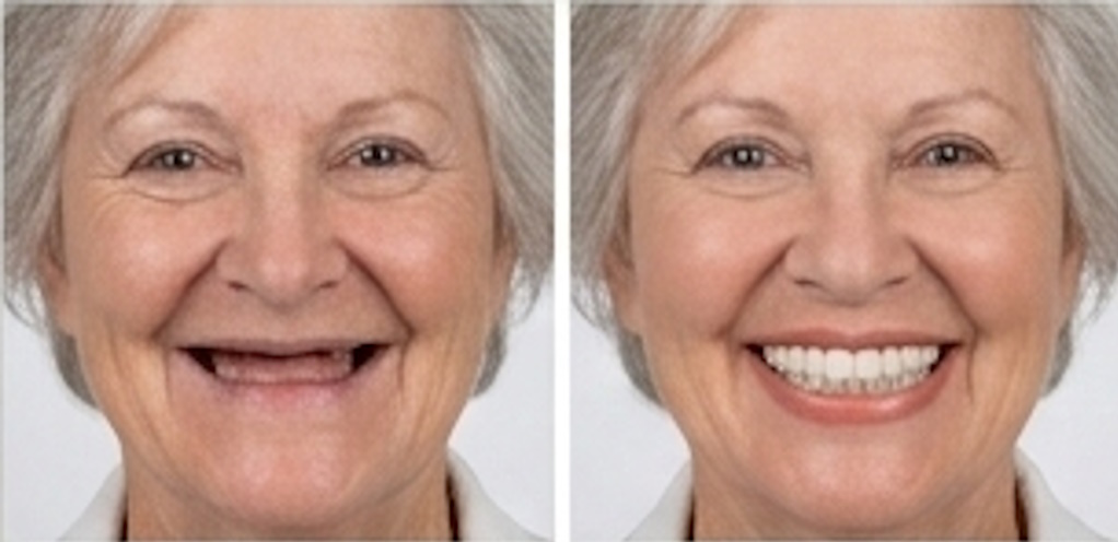 Flexible Valplast dentures
