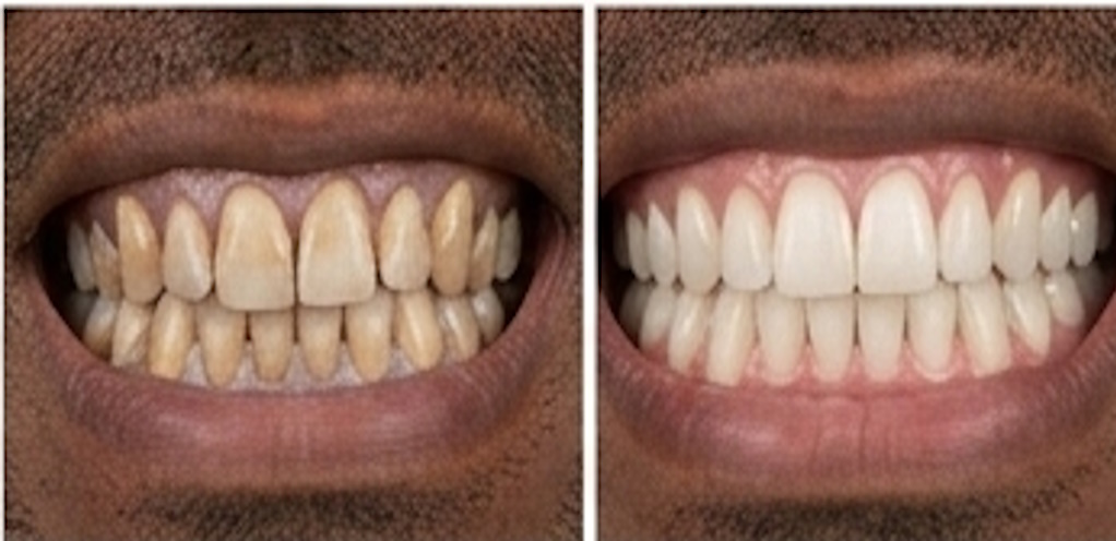 Dental hygienist performing a professional cleaning