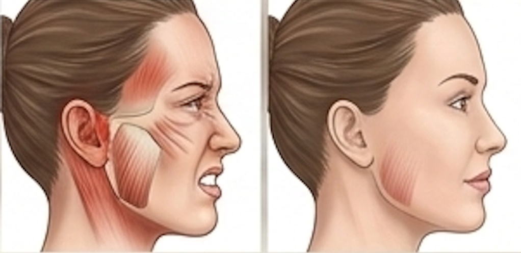 Diagram showing jaw joint and muscles affected by TMD