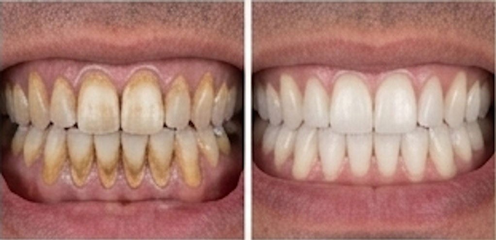 Bright smile after teeth whitening