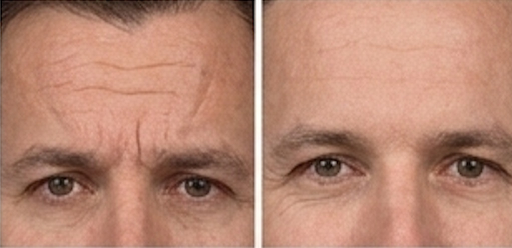 Treatment for lines and wrinkles on forehead and around eyes